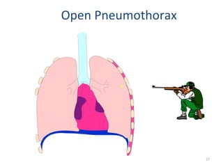 Open Pneumothorax
27
 