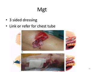 Mgt
• 3 sided dressing
• Link or refer for chest tube
30
 