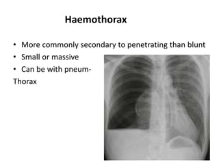 Haemothorax
• More commonly secondary to penetrating than blunt
• Small or massive
• Can be with pneum-
Thorax
31
 