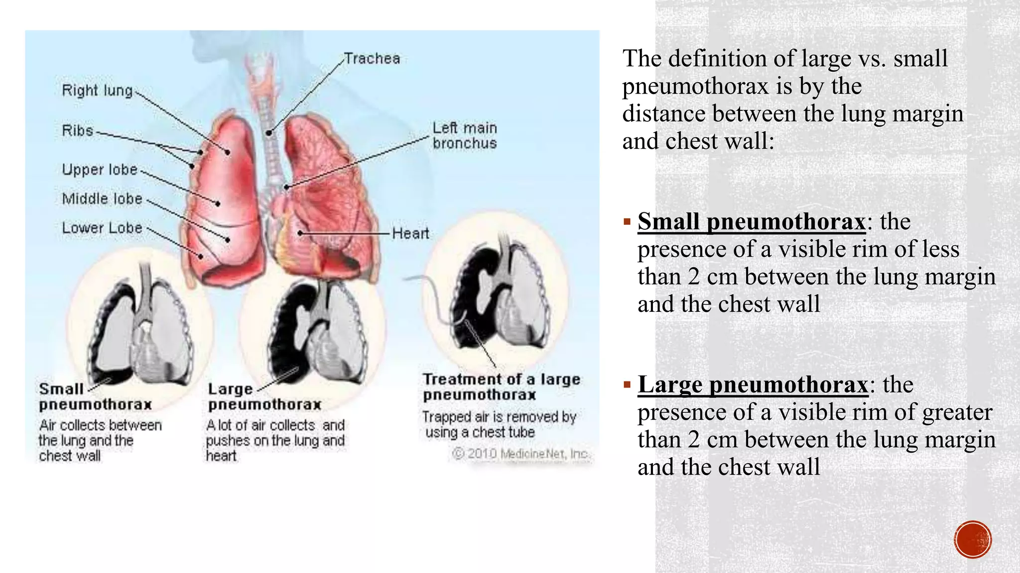 Distance Chest Chest Trauma .pptx