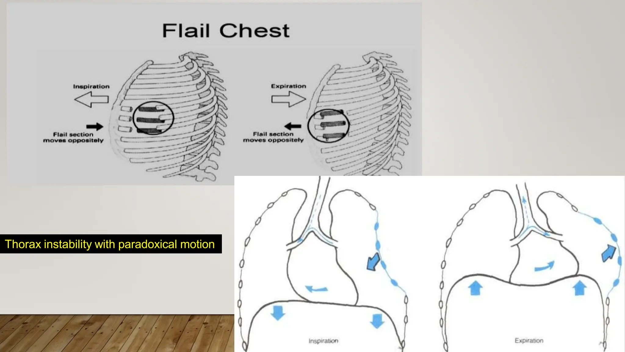 Chest Trauma MBBS teaching in Lilongwe Malawi | PPT