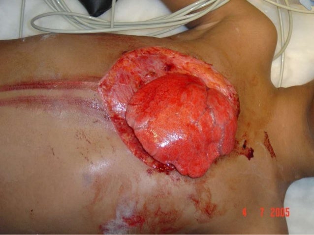 Chest trauma pg