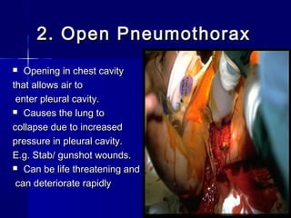 2. Open Pneumothorax2. Open Pneumothorax
 Opening in chest cavityOpening in chest cavity
that allows air tothat allows air to
enter pleural cavity.enter pleural cavity.
 Causes the lung toCauses the lung to
collapse due to increasedcollapse due to increased
pressure in pleural cavity.pressure in pleural cavity.
E.g. Stab/ gunshot wounds.E.g. Stab/ gunshot wounds.
 Can be life threatening andCan be life threatening and
can deteriorate rapidlycan deteriorate rapidly
 