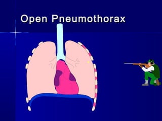 Open PneumothoraxOpen Pneumothorax
 