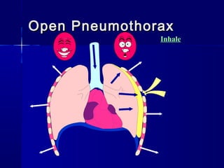 Open PneumothoraxOpen Pneumothorax
Inhale
 