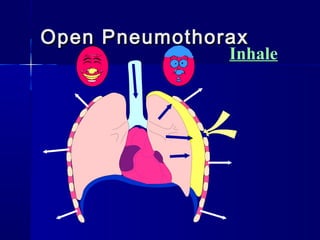Open PneumothoraxOpen Pneumothorax
Inhale
 