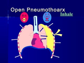 Open PneumothoarxOpen Pneumothoarx
Inhale
 
