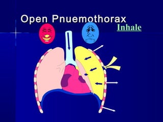 Open PnuemothoraxOpen Pnuemothorax
Inhale
 