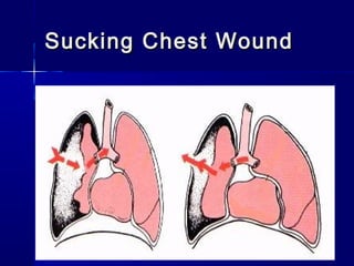 Sucking Chest WoundSucking Chest Wound
 