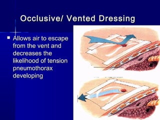 Occlusive/ Vented DressingOcclusive/ Vented Dressing
 Allows air to escapeAllows air to escape
from the vent andfrom the vent and
decreases thedecreases the
likelihood of tensionlikelihood of tension
pneumothoraxpneumothorax
developingdeveloping
 