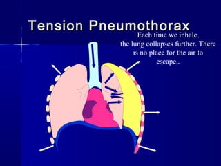 Tension PneumothoraxTension Pneumothorax
Each time we inhale,
the lung collapses further. There
is no place for the air to
escape..
 