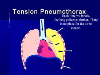 Tension PneumothoraxTension Pneumothorax
Each time we inhale,
the lung collapses further. There
is no place for the air to
escape..
 