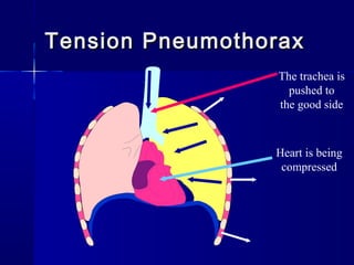 Tension PneumothoraxTension Pneumothorax
Heart is being
compressed
The trachea is
pushed to
the good side
 