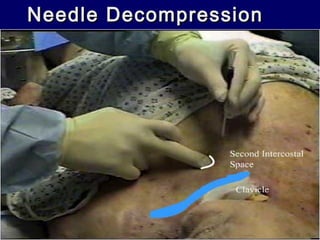 Needle DecompressionNeedle Decompression
 