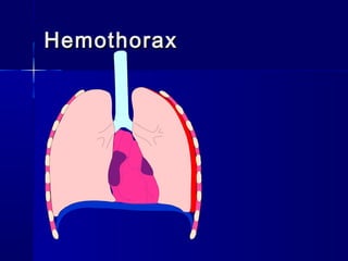 HemothoraxHemothorax
 