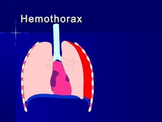 HemothoraxHemothorax
 