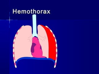 HemothoraxHemothorax
 