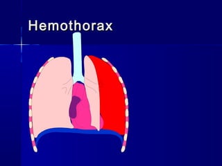 HemothoraxHemothorax
 