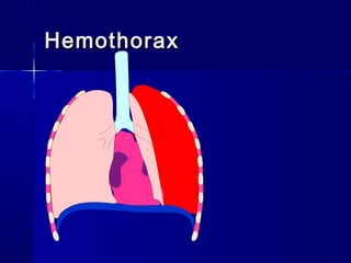 HemothoraxHemothorax
 