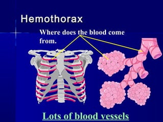 HemothoraxHemothorax
Lots of blood vessels
Where does the blood come
from.
 