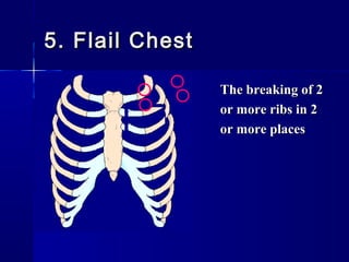 5. Flail Chest5. Flail Chest
The breaking of 2The breaking of 2
or more ribs in 2or more ribs in 2
or more placesor more places
 