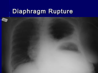 Diaphragm RuptureDiaphragm Rupture
 