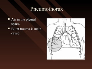 PneumothoraxPneumothorax
 Air in the pleuralAir in the pleural
space.space.
 Blunt trauma is mainBlunt trauma is main
causecause
 
