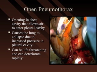 Open PneumothoraxOpen Pneumothorax
 Opening in chestOpening in chest
cavity that allows aircavity that allows air
to enter pleural cavityto enter pleural cavity
 Causes the lung toCauses the lung to
collapse due tocollapse due to
increased pressure inincreased pressure in
pleural cavitypleural cavity
 Can be life threateningCan be life threatening
and can deteriorateand can deteriorate
rapidlyrapidly
 