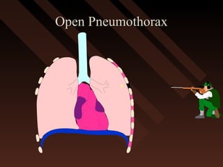 Open PneumothoraxOpen Pneumothorax
 