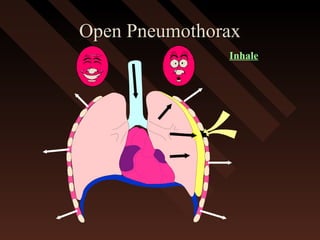 Open PneumothoraxOpen Pneumothorax
Inhale
 