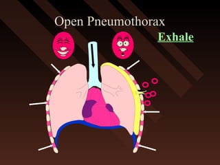 Open PneumothoraxOpen Pneumothorax
Exhale
 