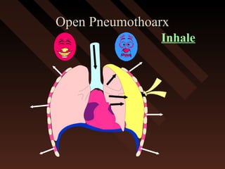 Open PneumothoarxOpen Pneumothoarx
Inhale
 