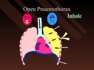 Open PnuemothoraxOpen Pnuemothorax
Inhale
 