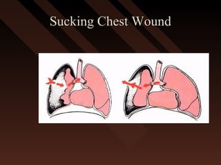 Sucking Chest WoundSucking Chest Wound
 
