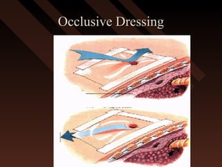 Occlusive DressingOcclusive Dressing
 