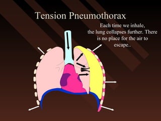 Tension PneumothoraxTension Pneumothorax
Each time we inhale,
the lung collapses further. There
is no place for the air to
escape..
 