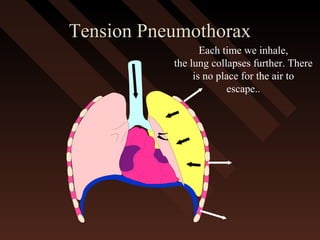 Tension PneumothoraxTension Pneumothorax
Each time we inhale,
the lung collapses further. There
is no place for the air to
escape..
 