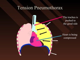 Tension PneumothoraxTension Pneumothorax
Heart is being
compressed
The trachea is
pushed to
the good side
 