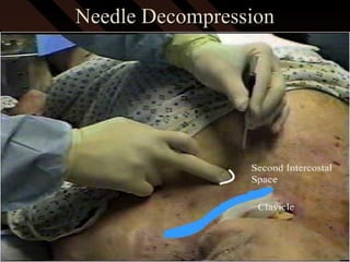 Needle DecompressionNeedle Decompression
 