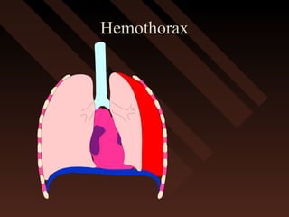 HemothoraxHemothorax
 