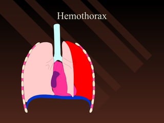 HemothoraxHemothorax
 