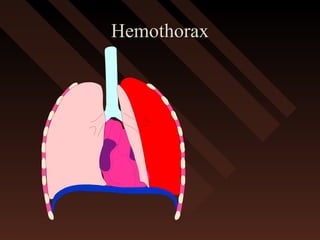 HemothoraxHemothorax
 