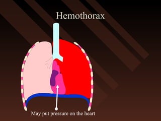 HemothoraxHemothorax
May put pressure on the heart
 