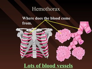 HemothoraxHemothorax
Lots of blood vessels
Where does the blood come
from.
 