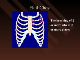 Flail ChestFlail Chest
The breaking of 2The breaking of 2
or more ribs in 2or more ribs in 2
or more placesor more places
 