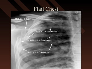 Flail ChestFlail Chest
 