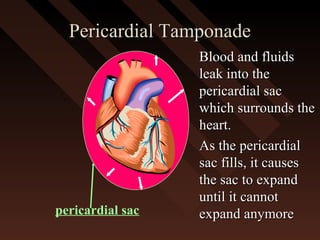 Pericardial TamponadePericardial Tamponade
Blood and fluidsBlood and fluids
leak into theleak into the
pericardial sacpericardial sac
which surrounds thewhich surrounds the
heart.heart.
As the pericardialAs the pericardial
sac fills, it causessac fills, it causes
the sac to expandthe sac to expand
until it cannotuntil it cannot
expand anymoreexpand anymorepericardial sac
 