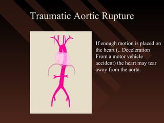 Traumatic Aortic RuptureTraumatic Aortic Rupture
If enough motion is placed on
the heart (.. Deceleration
From a motor vehicle
accident) the heart may tear
away from the aorta.
 