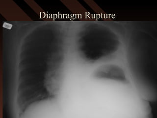 Diaphragm RuptureDiaphragm Rupture
 