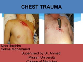 CHEST TRAUMA
Noor Ibrahim
Selma Mohammed
Supervised by Dr. Ahmed
Missan University
 